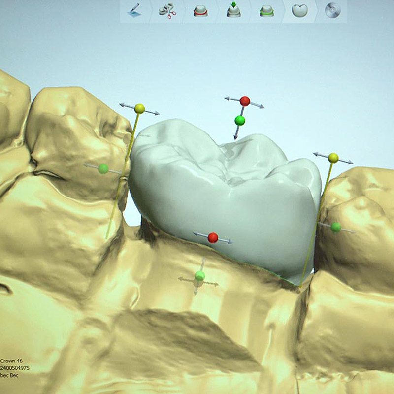 3D Digital Dentures
