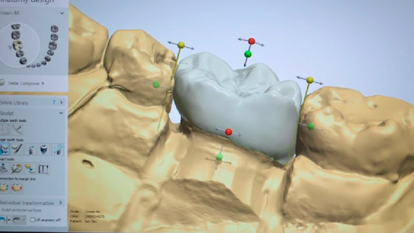 Digital Dentures