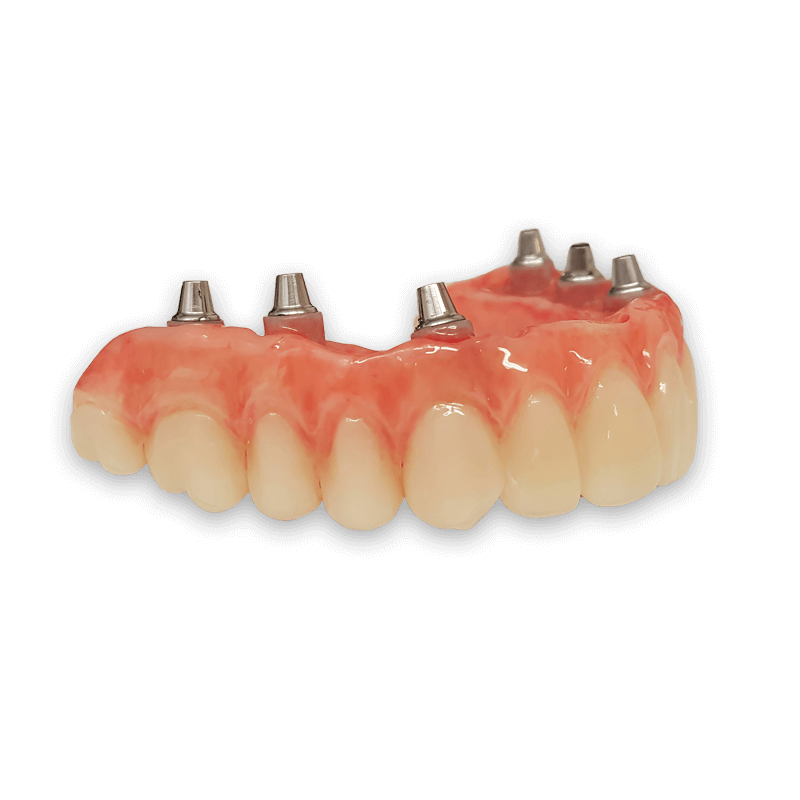 Implant-Supported-Dentures-Treatment Implant Supported Dentures