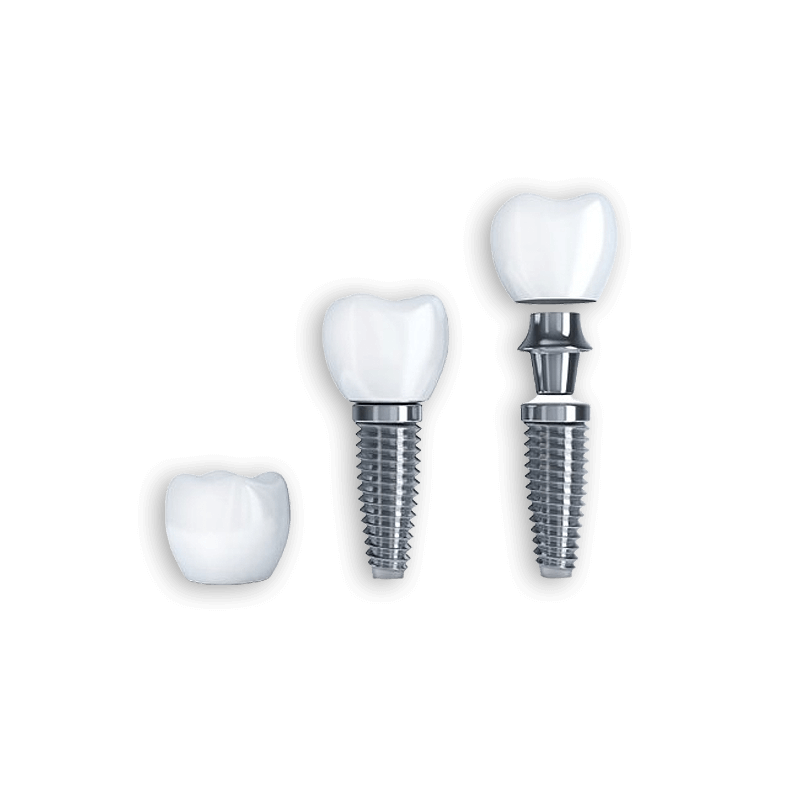 Dental-Implants-Treatment Dental Implants Treatment